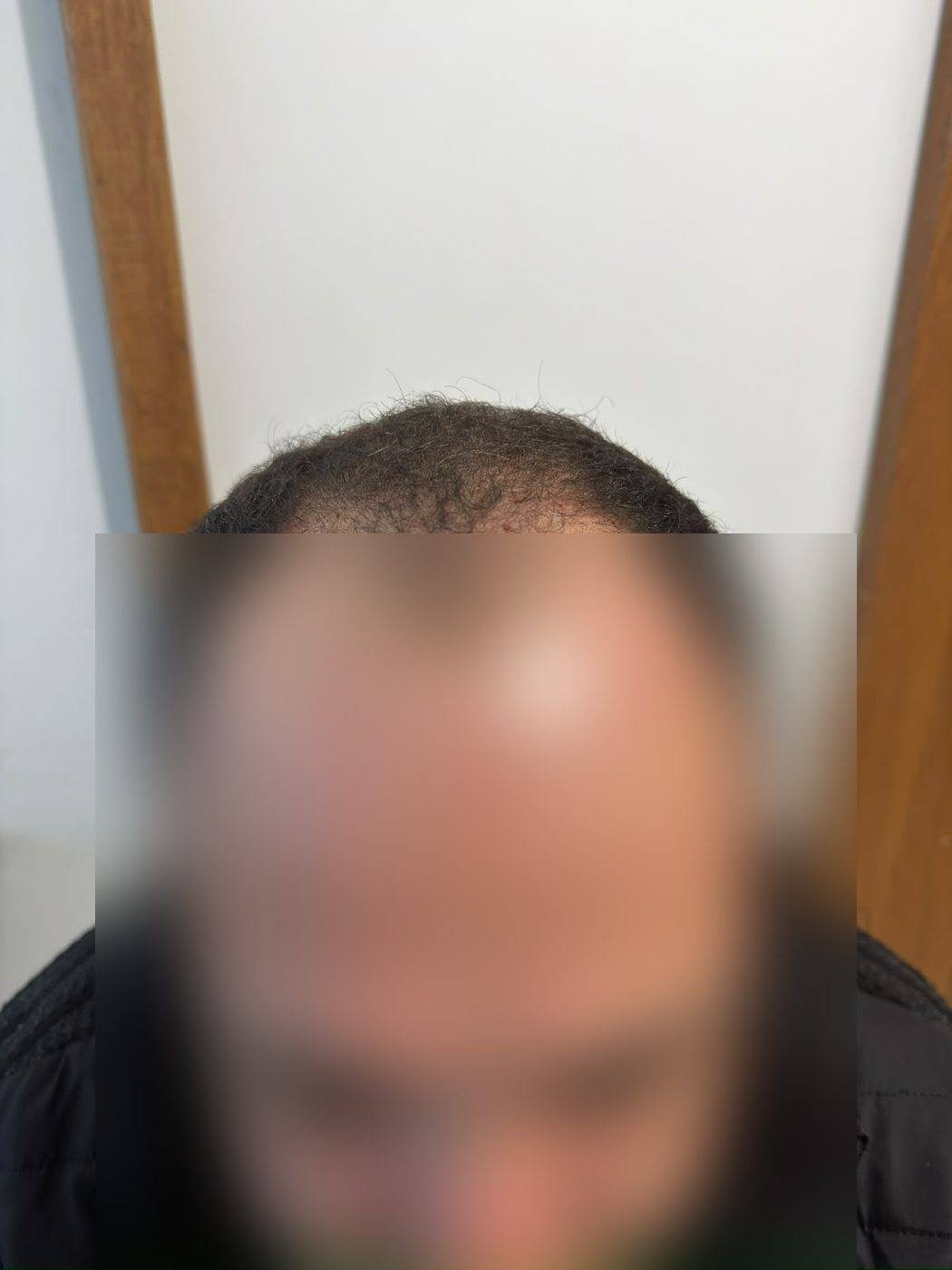 Antes: rarefação na linha frontal