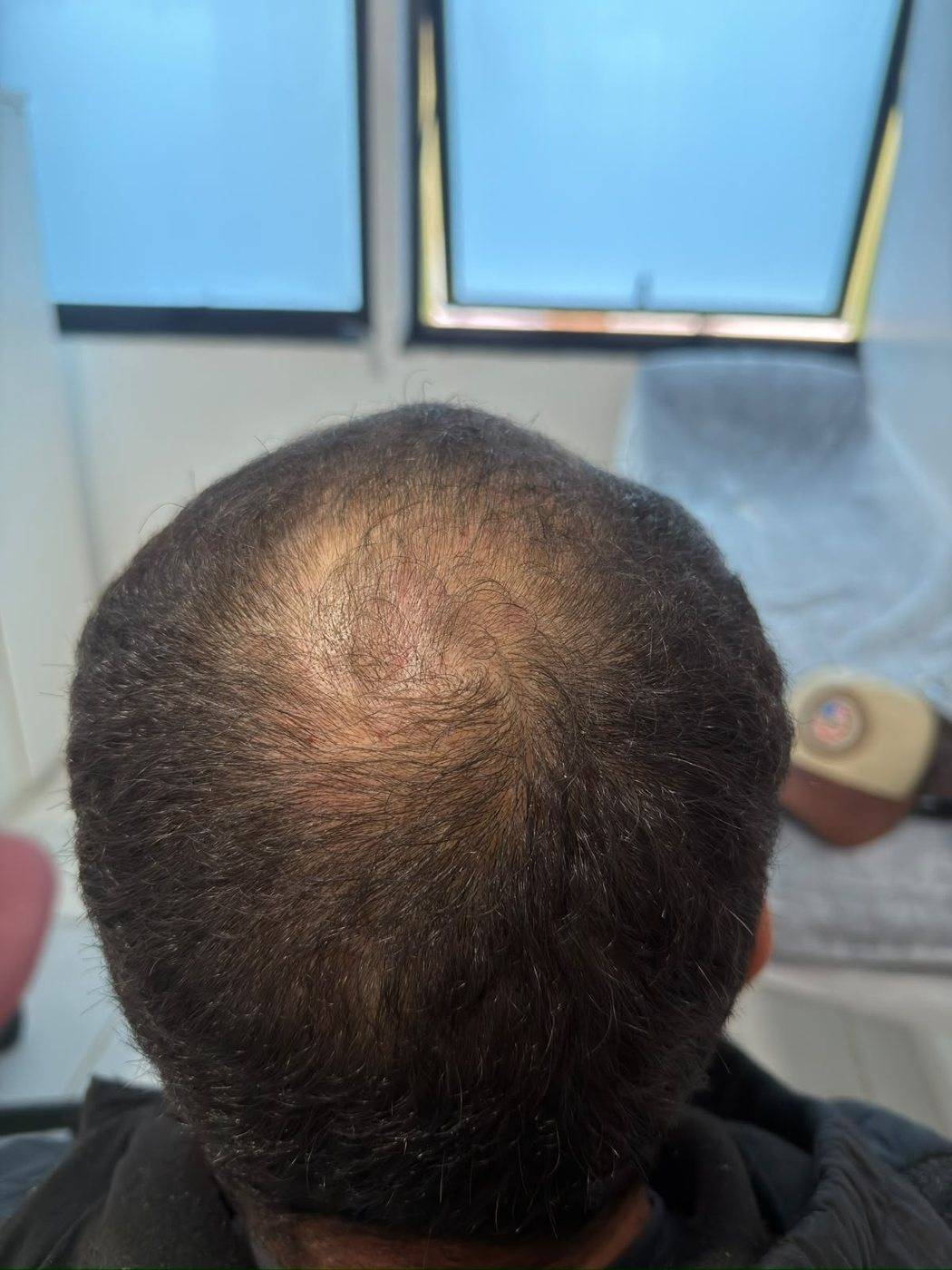 Antes: afinamento no topo e na coroa