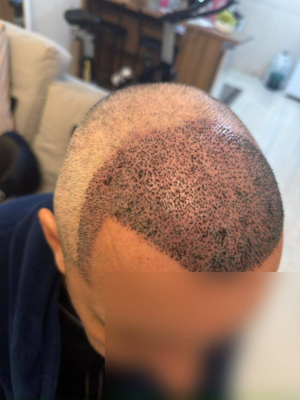 Pós-operatório: nova linha frontal desenhada