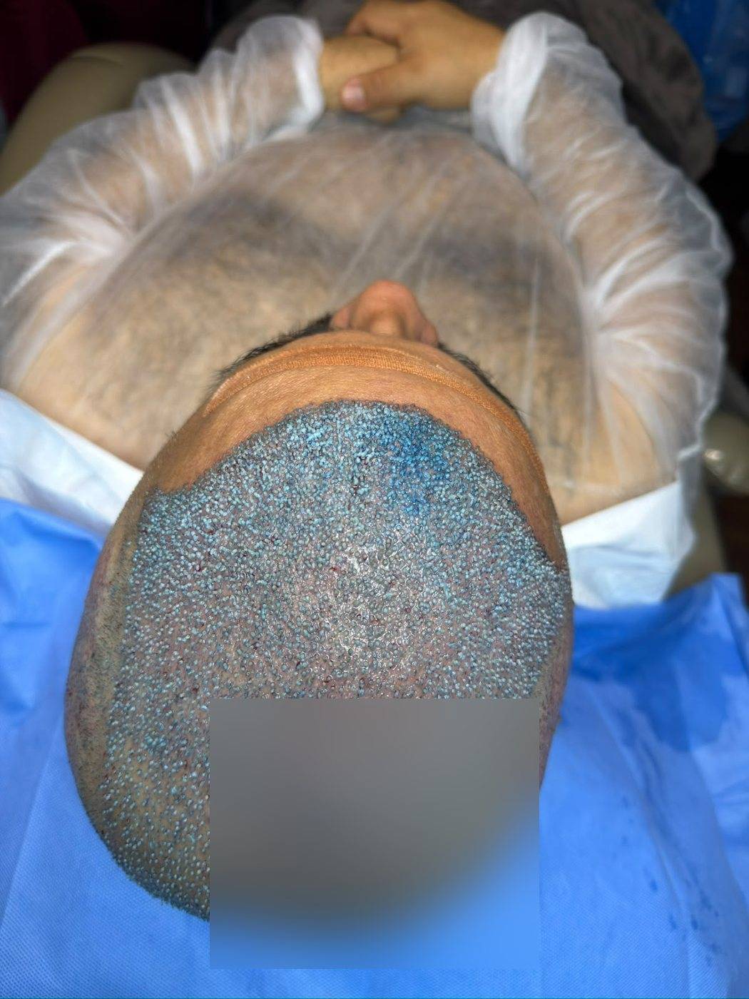 Dia do procedimento: topo e coroa implantados