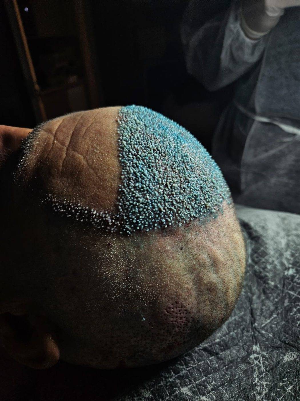 Dia do procedimento: linha frontal implantada