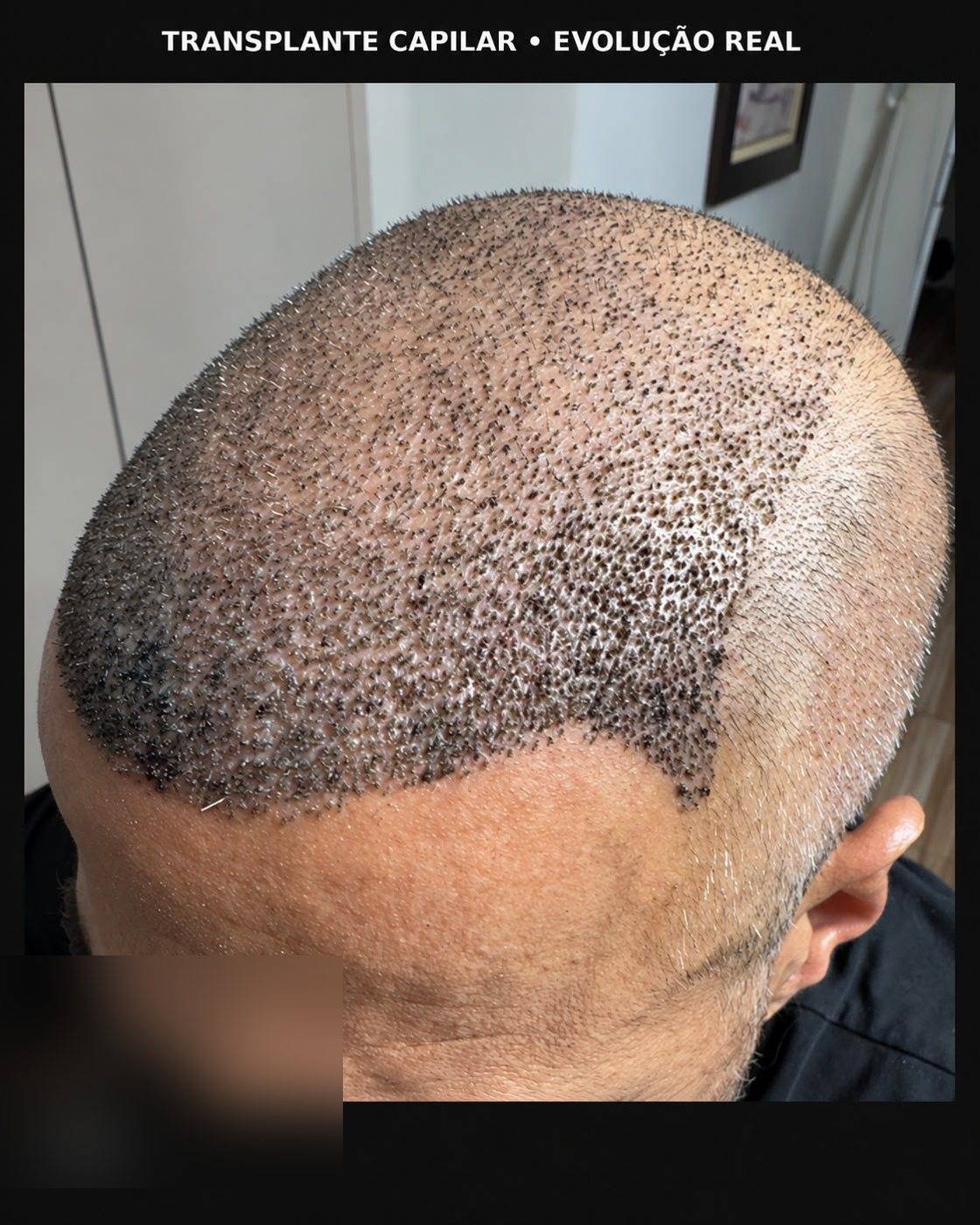 Evolução: linha frontal no 5º dia
