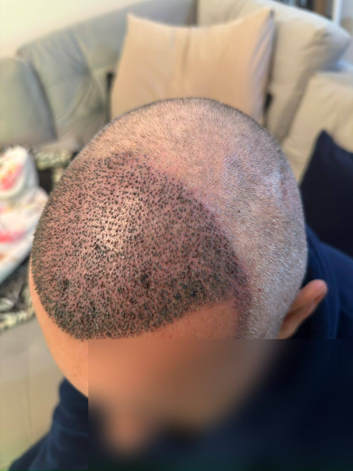 Pós-operatório: quando o cabelo transplantado cresce?