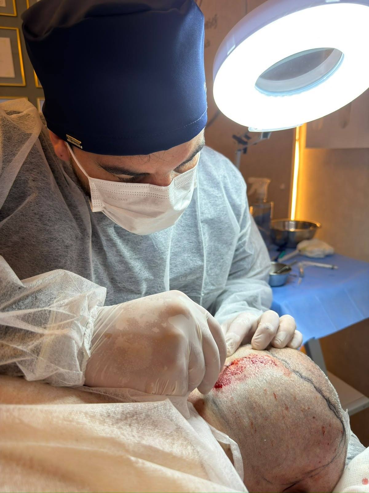 Transplante capilar FUE em Curitiba com o Dr. Marlon Busato